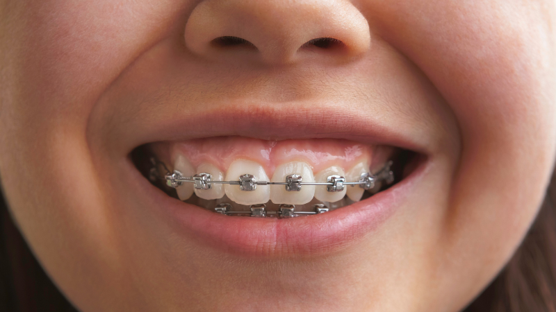 Orthodontic Evaluation