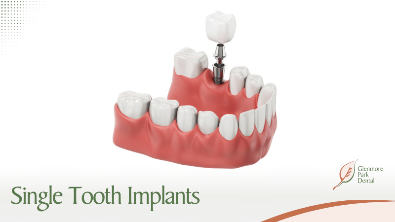 Single Tooth Implants