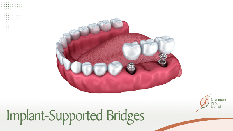 Implant-Supported Bridges