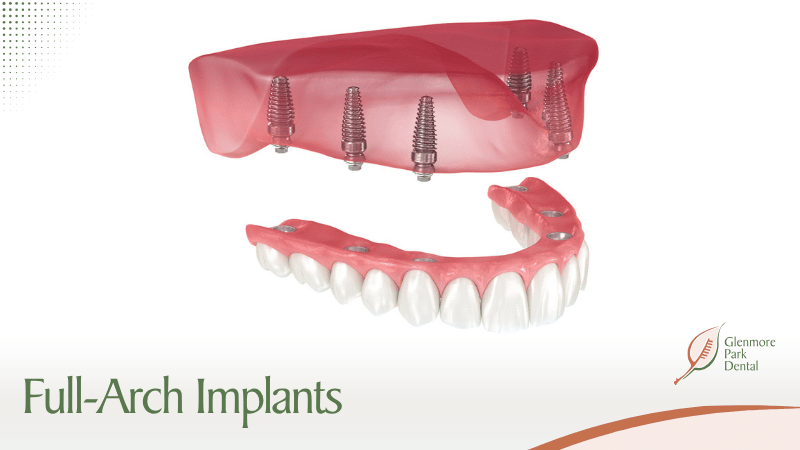 Full-Arch Implants