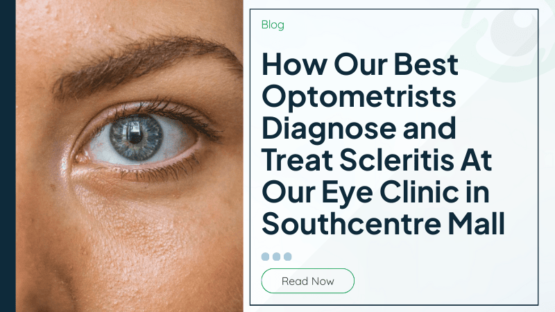 How Our Best Optometrists Diagnose and Treat Scleritis At Our Eye Clinic in Southcentre Mall