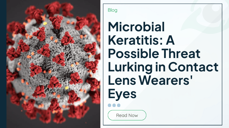 Microbial Keratitis: A Possible Threat Lurking in Contact Lens Wearers' Eyes