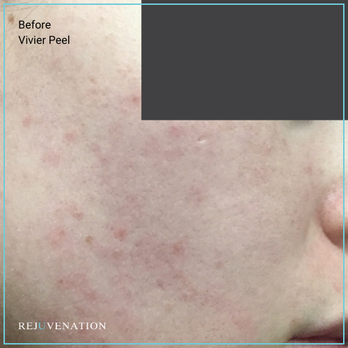 Vivier Peel 1