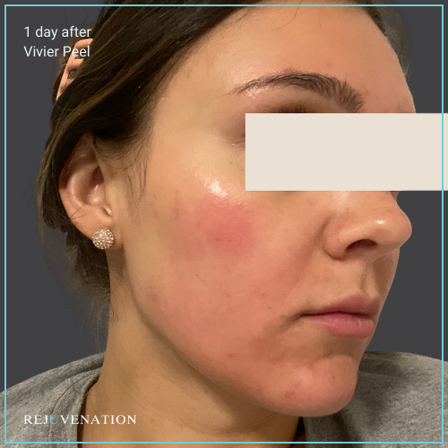 Vivier Peel 2