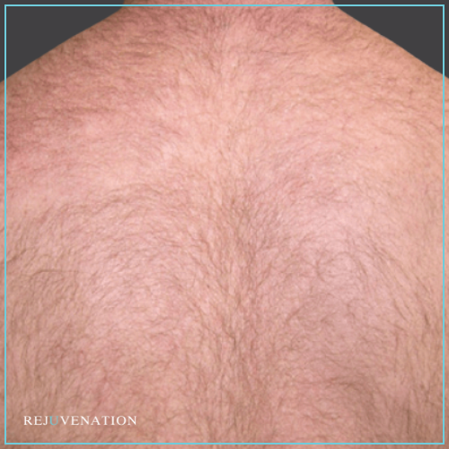 Laser Hair Removal 1