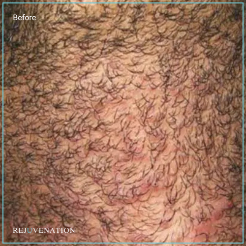 Laser Hair Removal 4