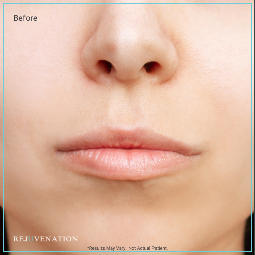 Lip Filler 1