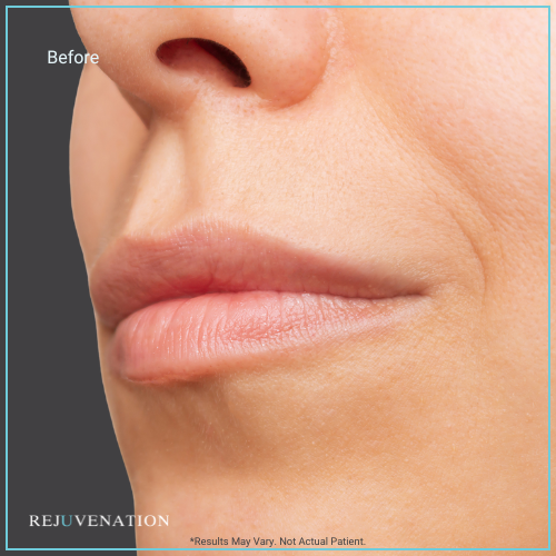 Lip Filler 2