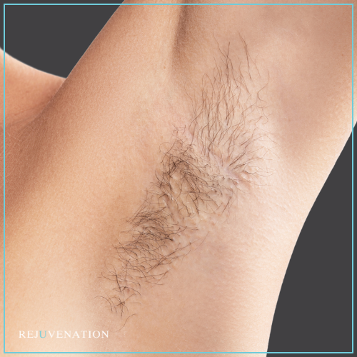 Laser Hair Removal 2