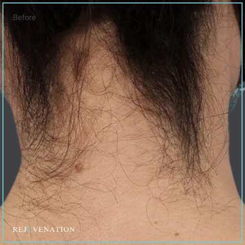 Laser Hair Removal 3
