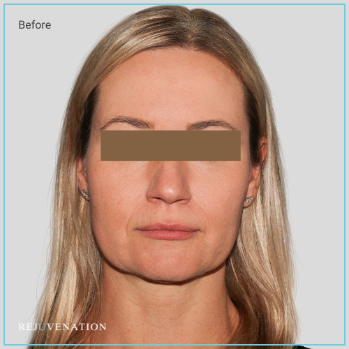  Dermal Fillers
