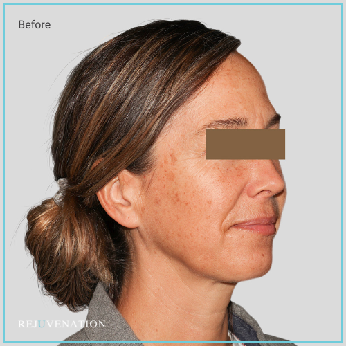 Rejuv Dermal fillers and Neuromodulators to chin