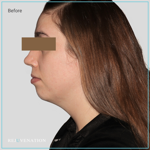 Rejuv Dermal filler and Neuromodulator to the lower face