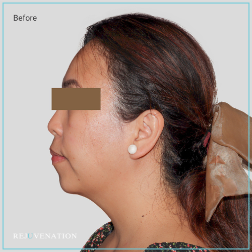 Rejuv Dermal filler and Neuromodulator to the lower face
