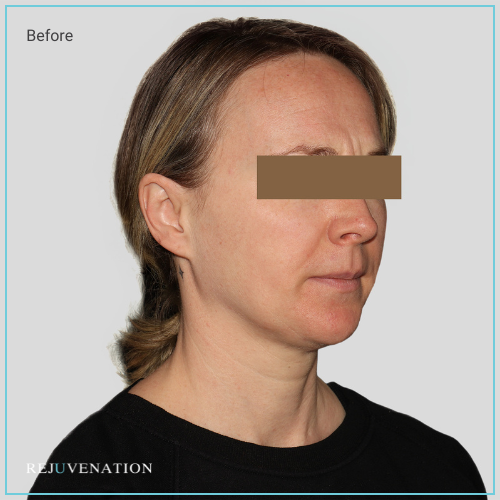 Rejuv filler to the upper and lower face