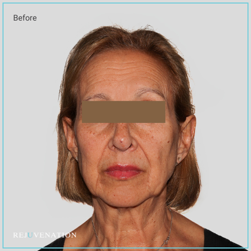 Rejuv filler to the upper and lower face to provide structure and target smile lines directly