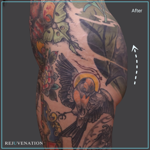 Side Left View Liquid Butt Lift Rejuvenation Medical Aesthetics
