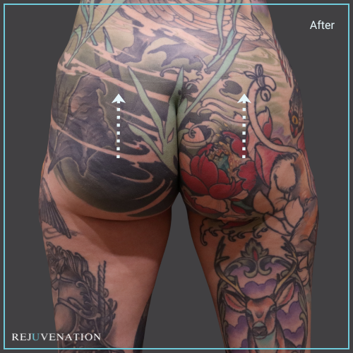 Back View Liquid Butt Lift Rejuvenation Medical Aesthetics