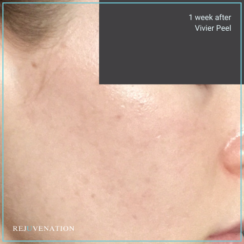 Vivier Peel 1