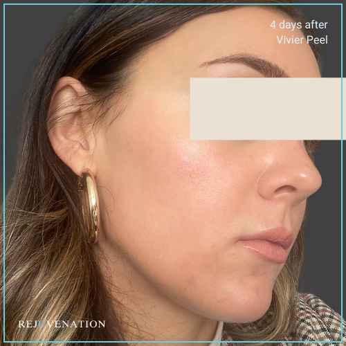 Vivier Peel 2