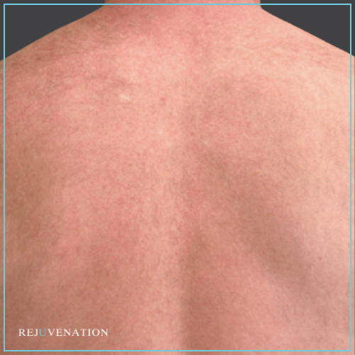 Laser Hair Removal 1