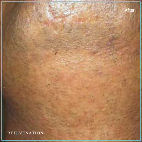 Laser Hair Removal 4