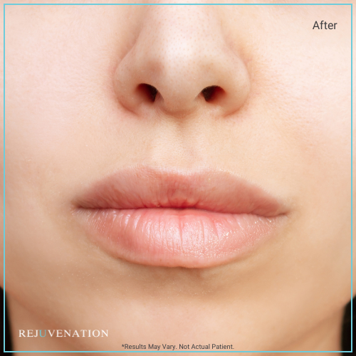 Lip Filler 1