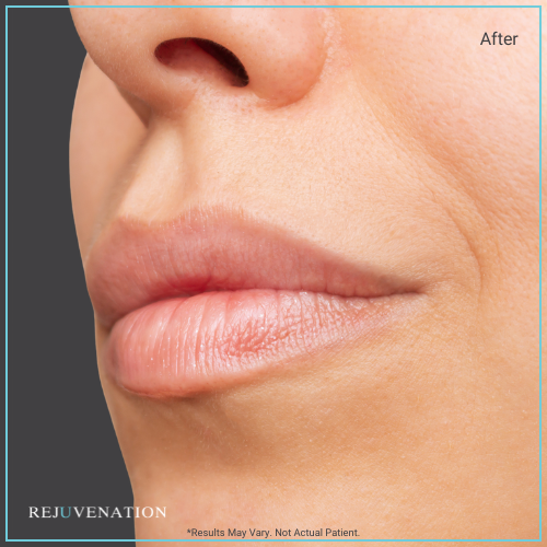 Lip Filler 2