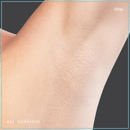 Laser Hair Removal 2