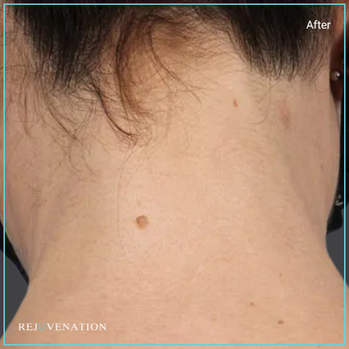 Laser Hair Removal 3