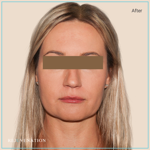  Dermal Fillers