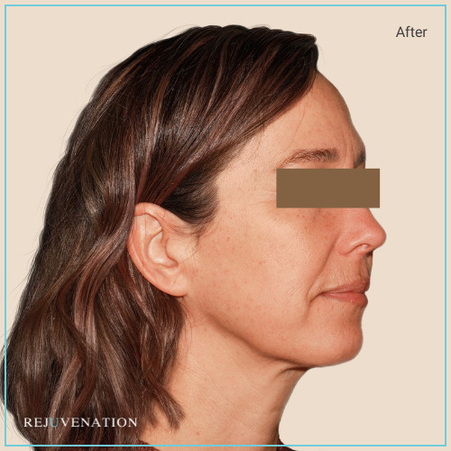 Rejuv Dermal fillers and Neuromodulators to chin