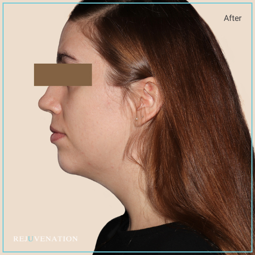 Rejuv Dermal filler and Neuromodulator to the lower face