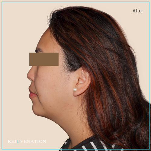 Rejuv Dermal filler and Neuromodulator to the lower face