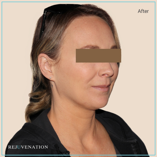 Rejuv filler to the upper and lower face