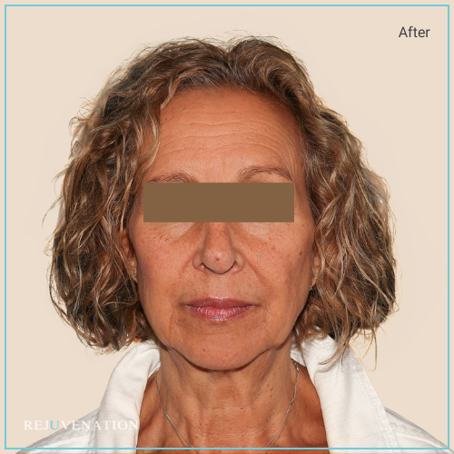 Rejuv filler to the upper and lower face to provide structure and target smile lines directly