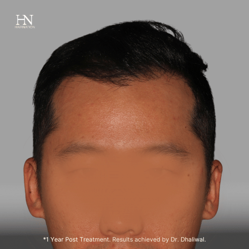 1 year post FUE - Before/After