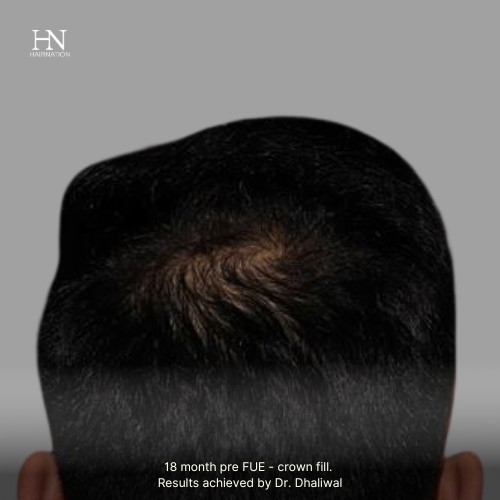 1 year post FUE Crown Fill - Before/After