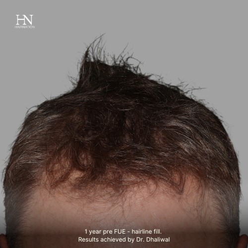1 year post FUE Hairline Fill - Before/After