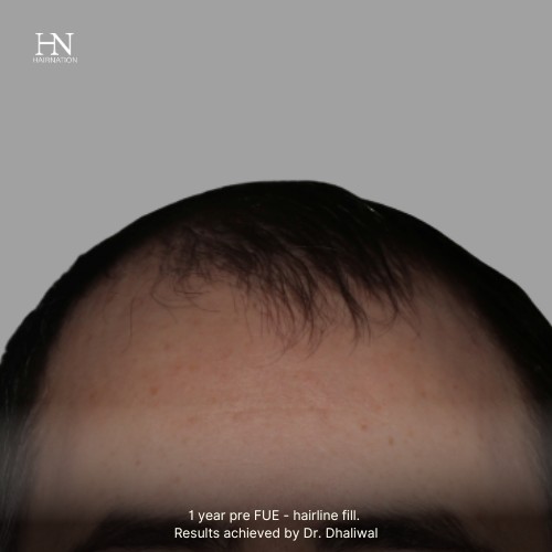 1 year post FUE Hairline Fill - Before/After