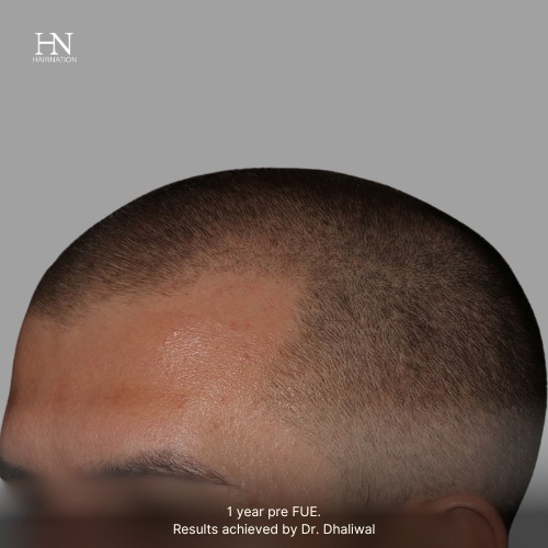 1 year post FUE Hairline Fill - Before/After
