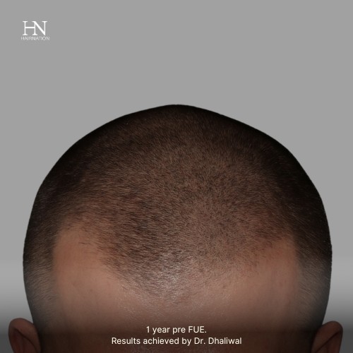 Pre/Post-FUE Hairline Transformation - 5