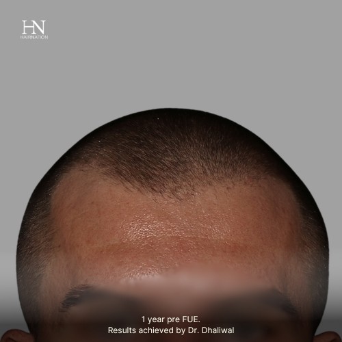 Pre/Post-FUE Hairline Transformation - 6
