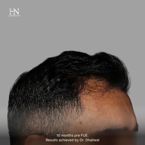 Pre/Post-FUE Hairline Transformation - 7