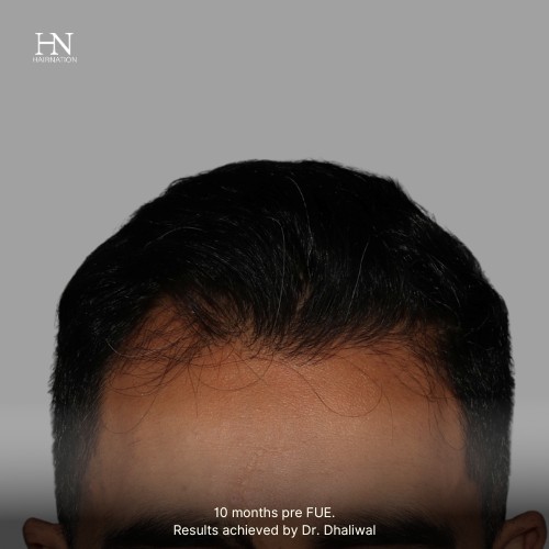 Pre/Post-FUE Hairline Transformation - 8