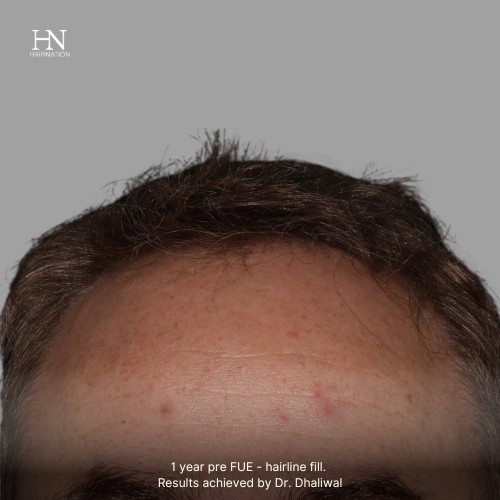 1 year post FUE Fill - Before/After