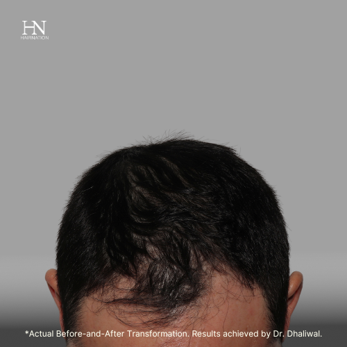  Pre & Post FUE 1 Year - Before/After 