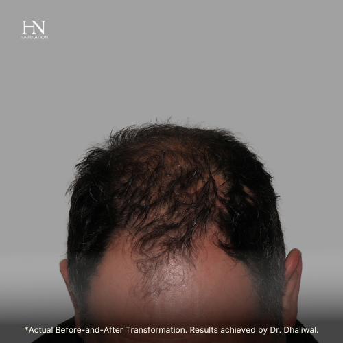  Pre & Post FUE June 1 - Before/After 
