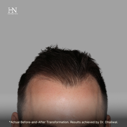  Pre & Post FUE June (1) - Before/After  