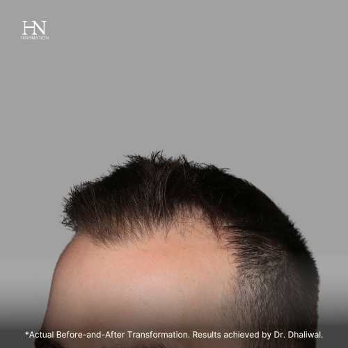  Pre & Post FUE June (2) - Before/After  
